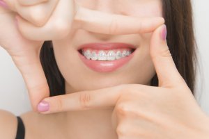 Les critères de choix d'une mutuelle pour orthodontie !
